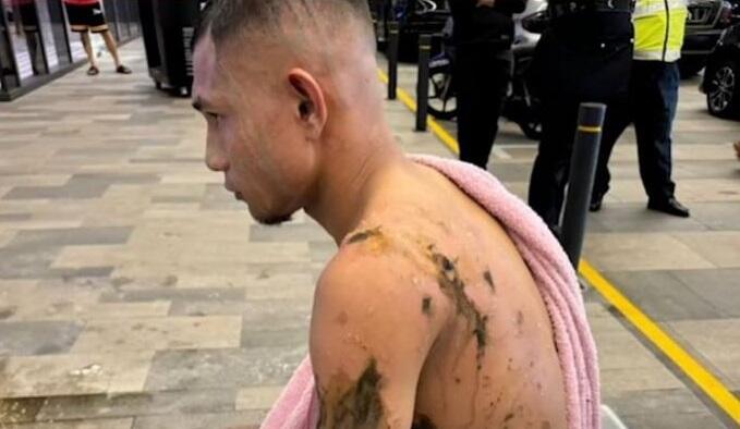Στην εντατική διεθνής άσος της Μαλαισίας μετά από επίθεση με καυστικό υγρό thumb